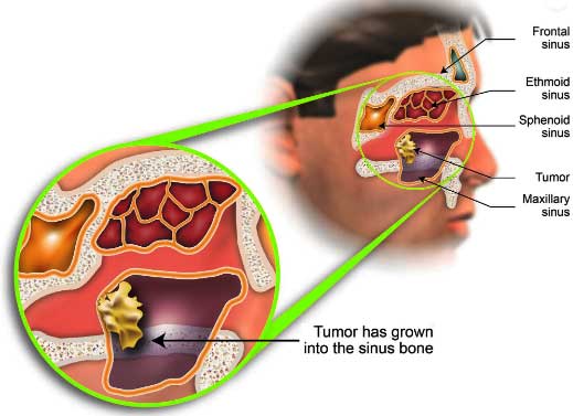 sinus cancer surgery in hyderabad